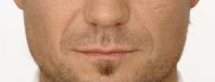 BL_Nose-to-mouth_Before.jpg BL_Nose-to-mouth_Before.jpg